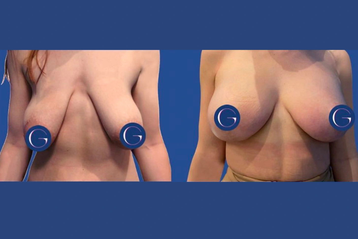 breast lift 3