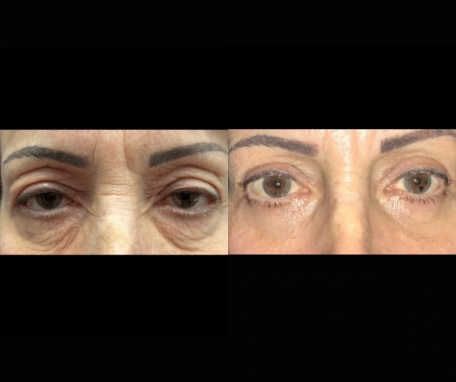 Blepharoplasty Result 2