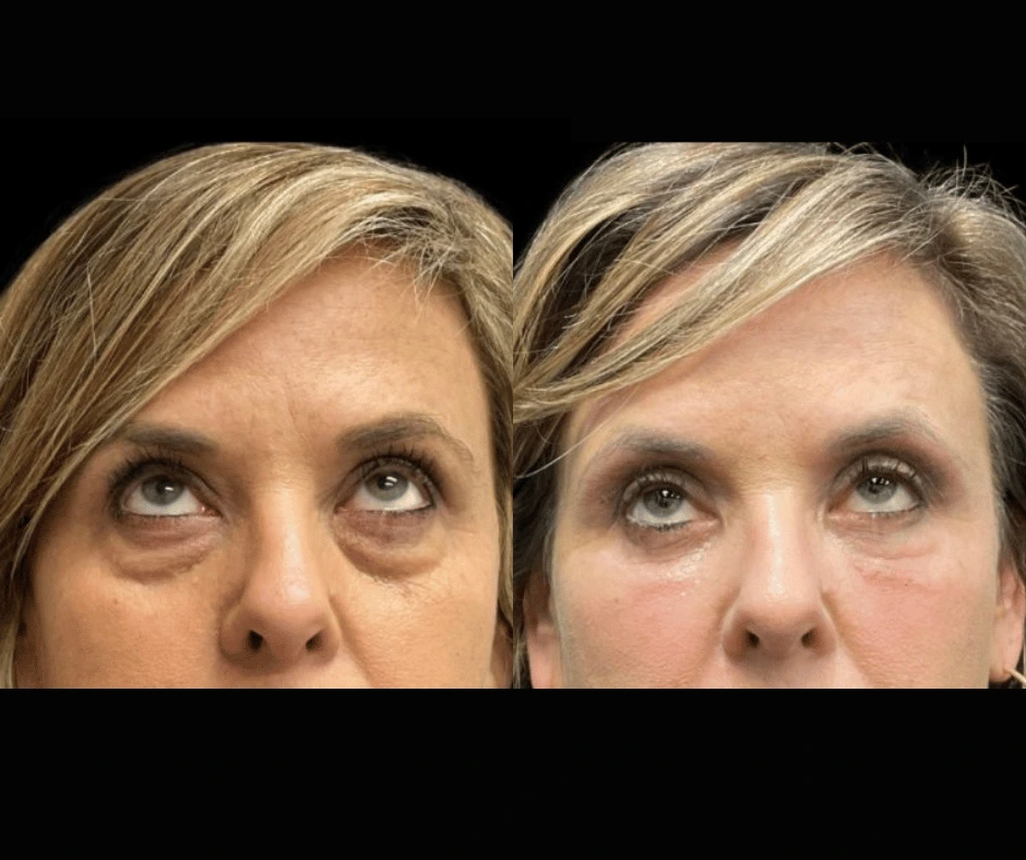 Blepharoplasty Result 3