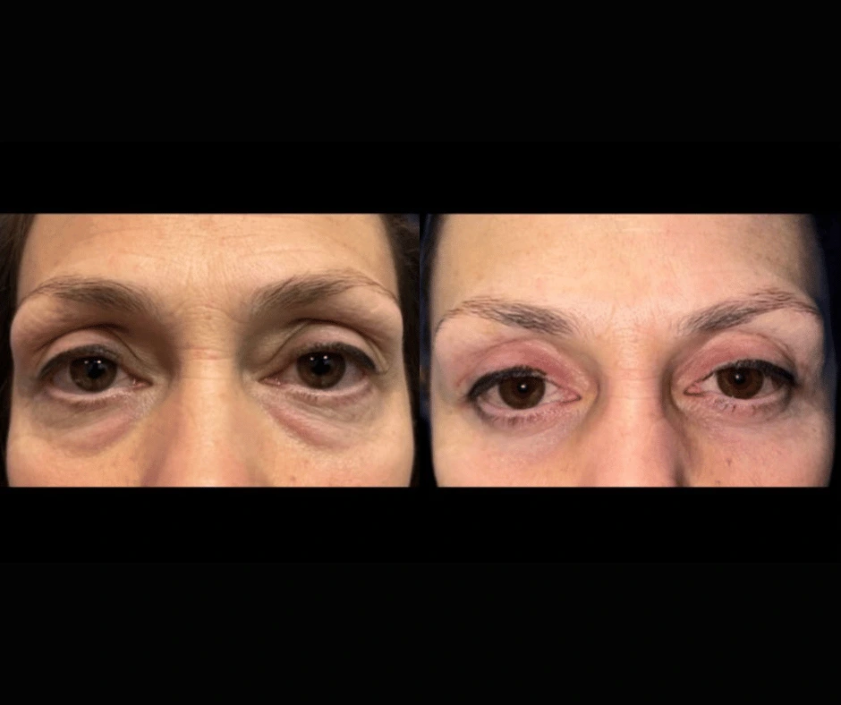 Blepharoplasty Result