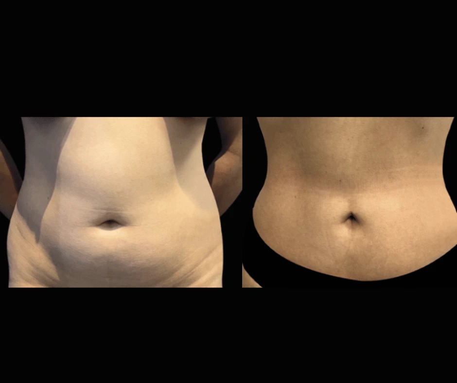 Lipo Results Dr. Greenberg (2)
