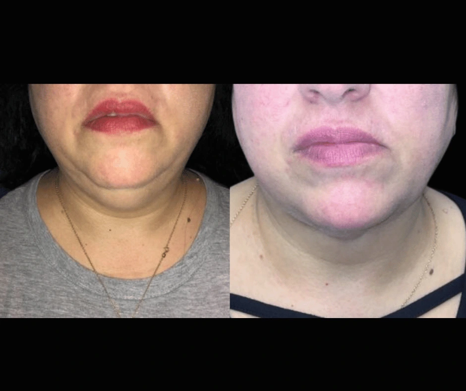 Lipo Results Dr. Greenberg