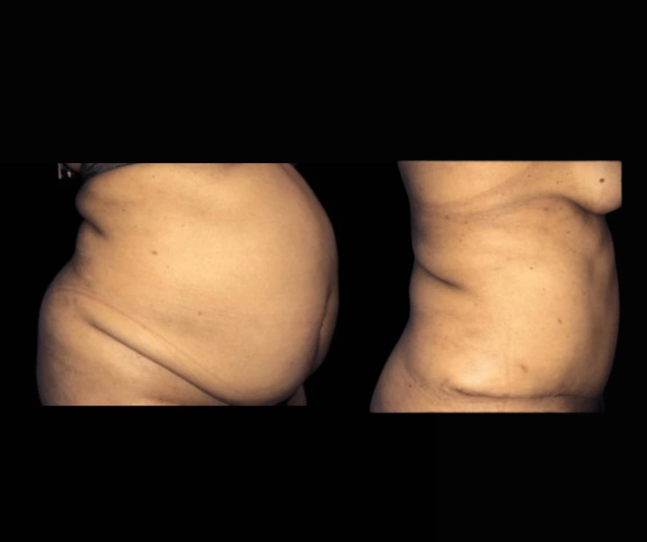 Tummy Tuck Results Dr. Greenberg (1)