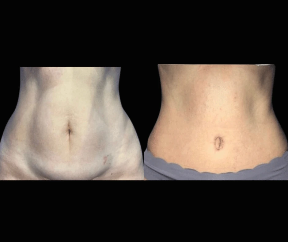 Tummy Tuck Results Dr. Greenberg (4)