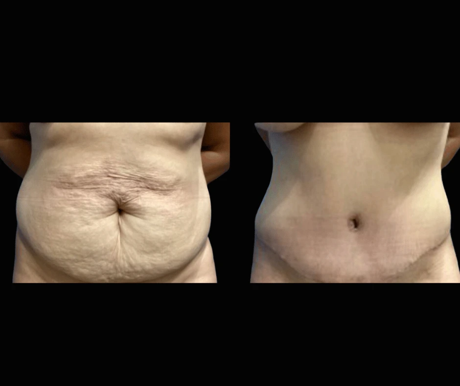 Tummy Tuck Results Dr. Greenberg