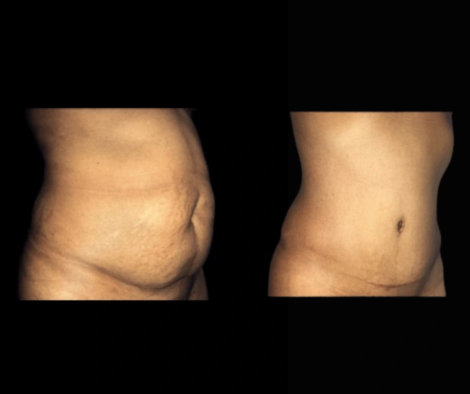 Tummy Tuck Results Dr. Greenberg